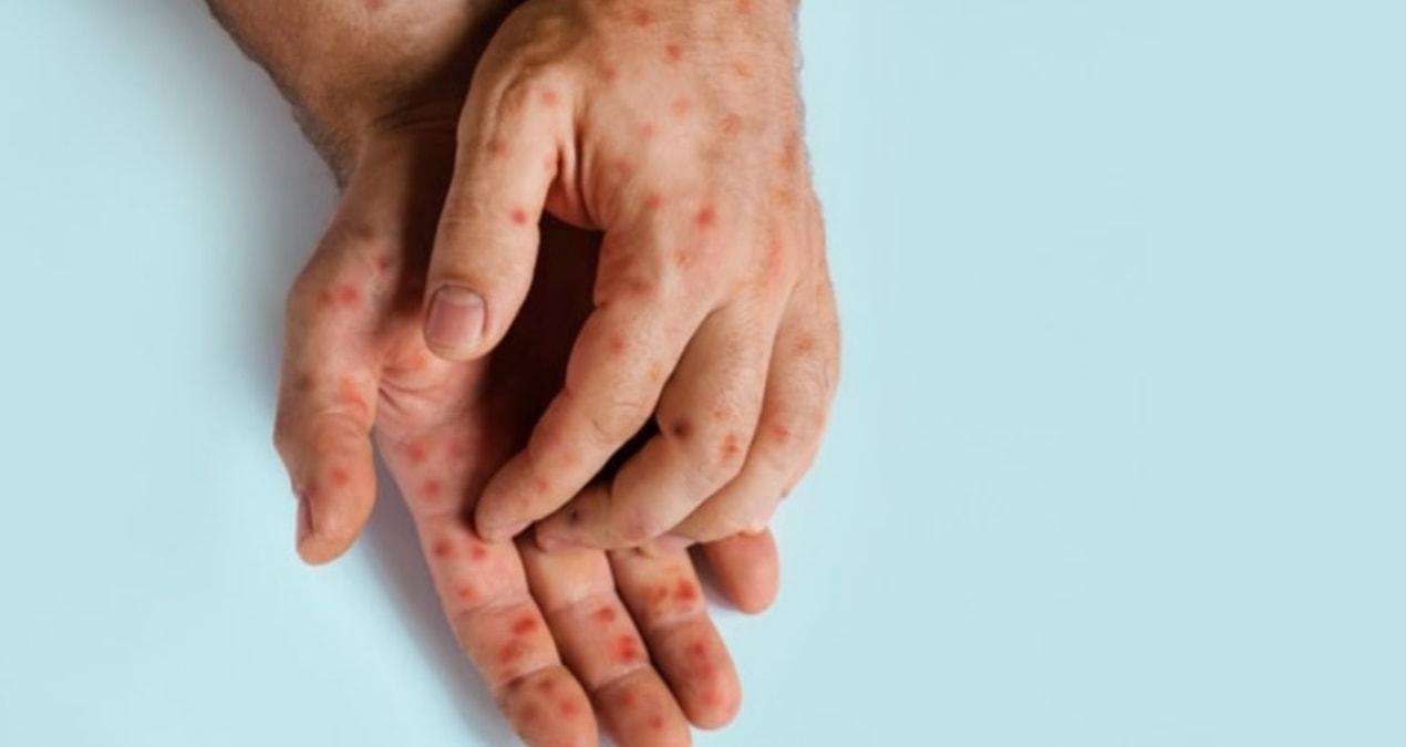 M Çiçeği yeni Covid-19 mu?