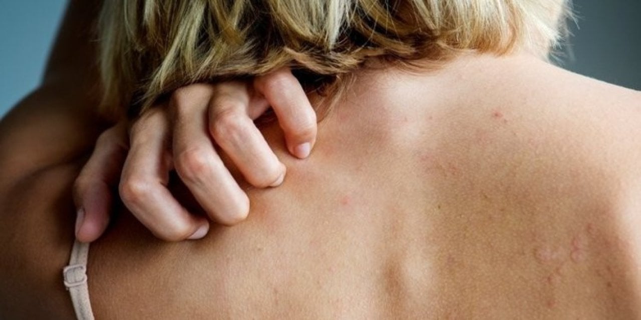 Uyuz vakaları her geçen gün artıyor