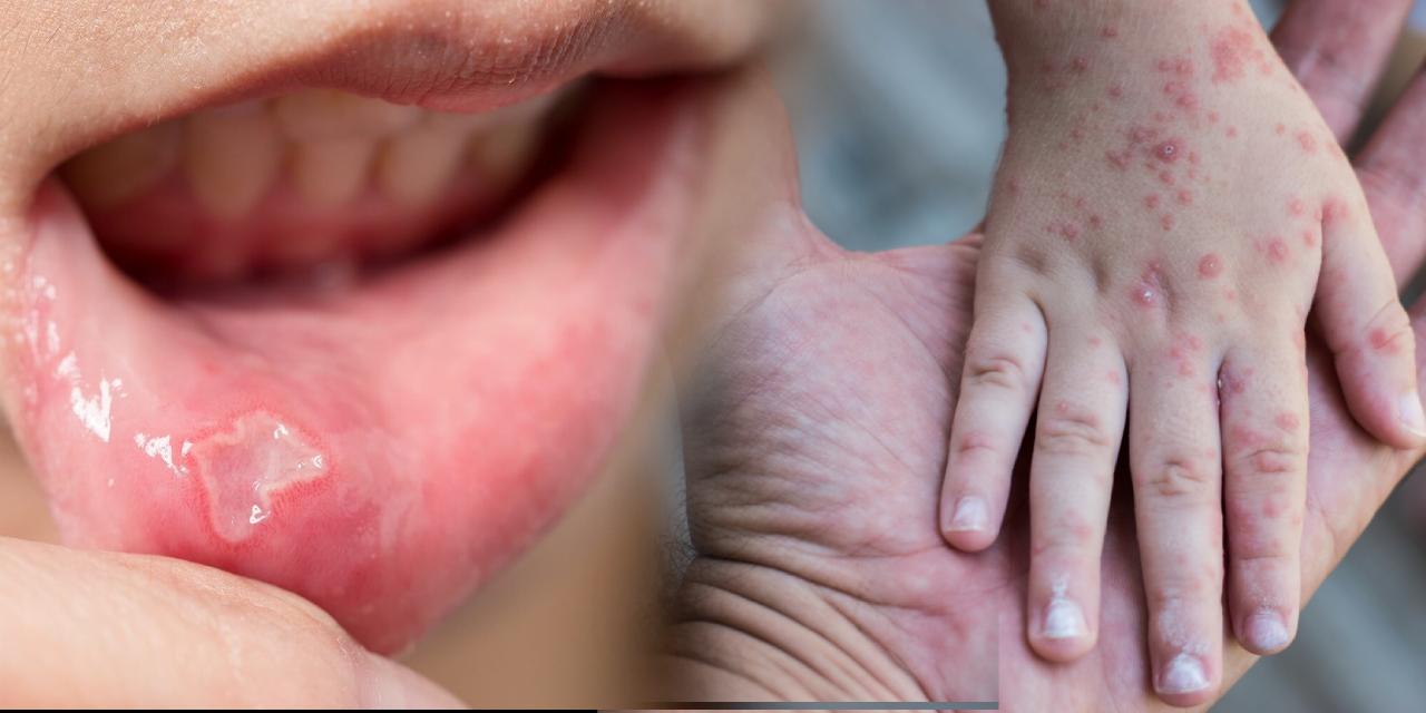 Çocuklardaki bu hastalık el ve ağızda yara yapıyor